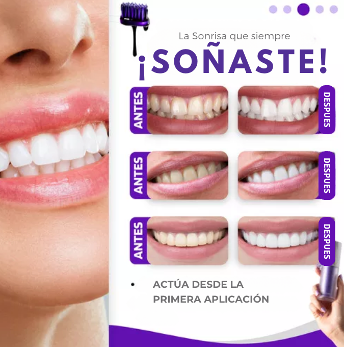 Blanqueador Dental | SmileKit - OFERTA 2X1